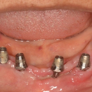 Implants13