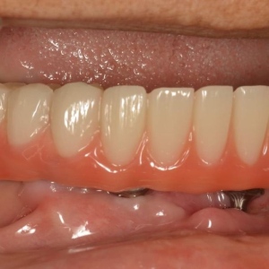 Implants14
