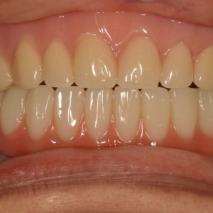 Implants15