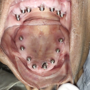Implants3