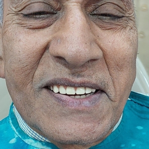 Implants4