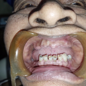 Implants5