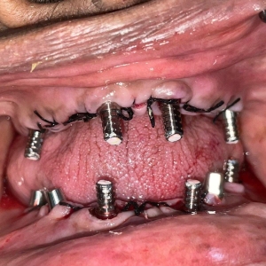 Implants6