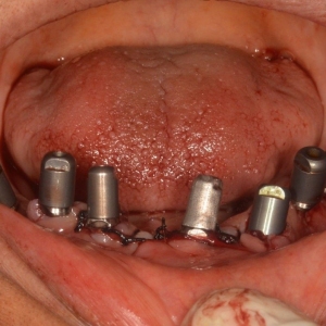 Implants9